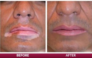 Vitiligo Treatment in Bhopal showing before and after skin repigmentation results