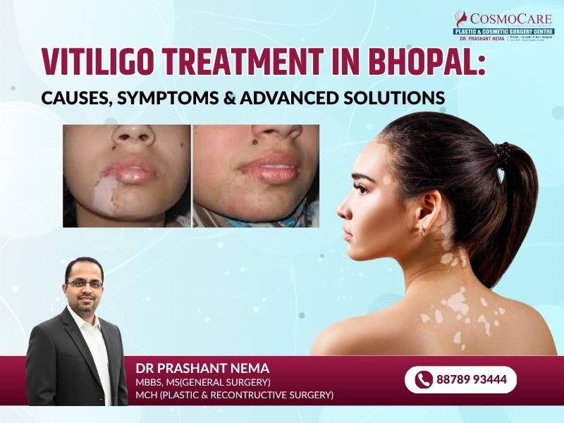 Vitiligo Treatment in Bhopal: Causes, Symptoms & Advanced Solutions