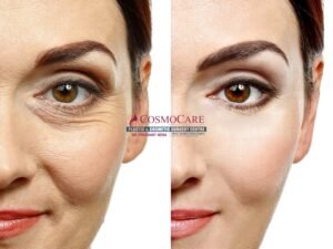 Best Facial Rejuvenation Treatment in Bhopal using Nano Fat Transfer for natural youthful skin improvement